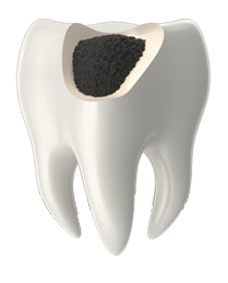 Endodoncia en El Casar | Oeste Dental - Clínica dental en El Casar