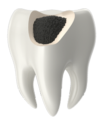 Endodoncia en El Casar | Oeste Dental – Clínica dental en El Casar Endodoncia en El Casar | Oeste Dental - Clínica dental en El Casar