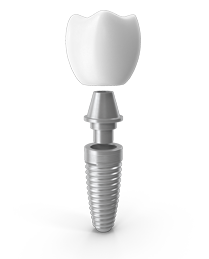 Implantes dentales en El Casar | Oeste Dental - Clínica dental en El Casar