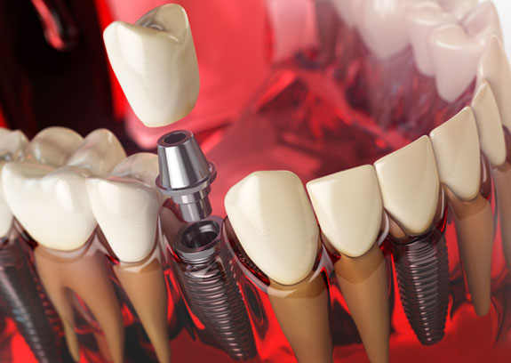 Implantes dentales en El Casar | Oeste Dental - Clínica dental en El Casar
